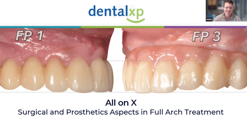 All on X: Surgical and Prosthetics Aspects in Full Arch Treatment
