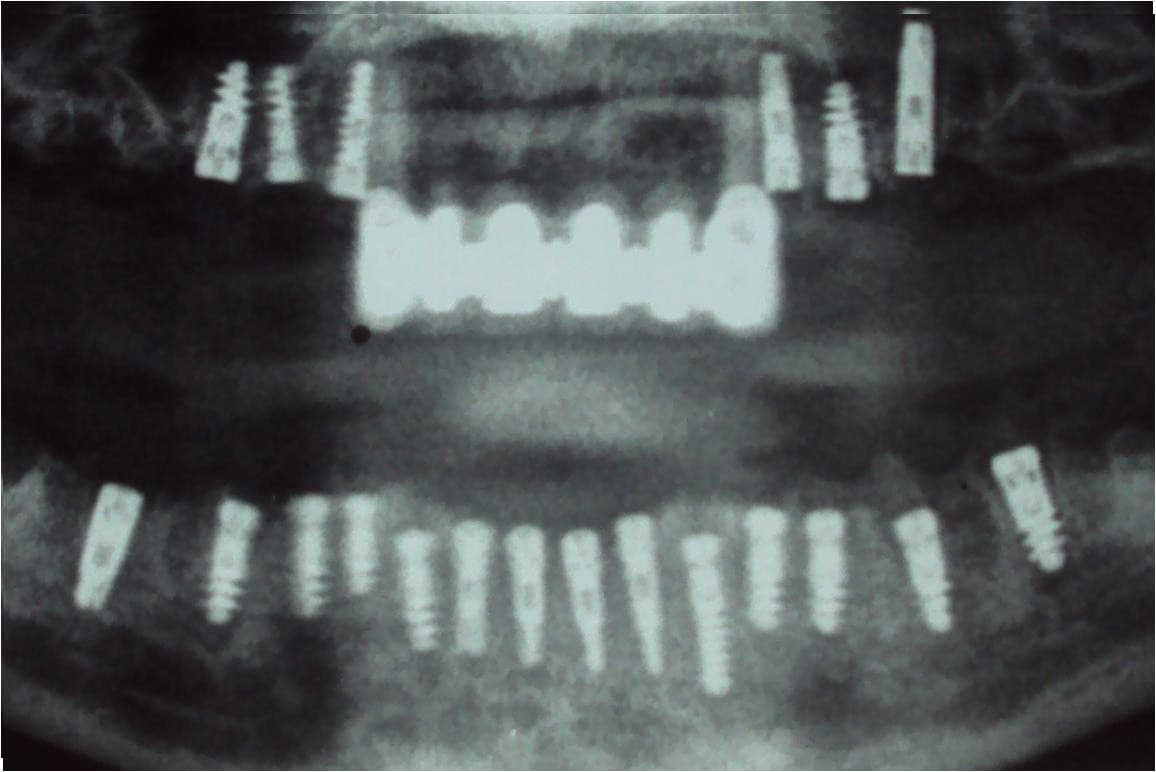 is-content-caseimages--1104-anshul rai 20 implants.jpg