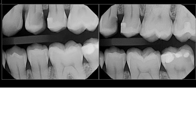 is-content-caseimages--7120-1_xray.jpg