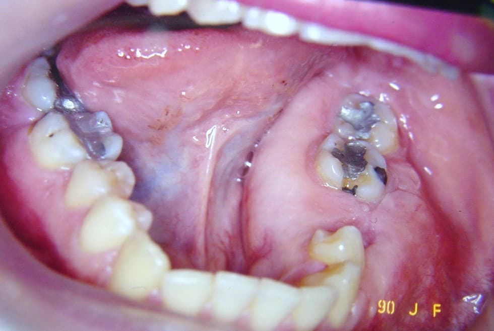 is-content-caseimages--311-0STEO FIBROSIS OSEALAURA PAGINA WEB 004.jpg