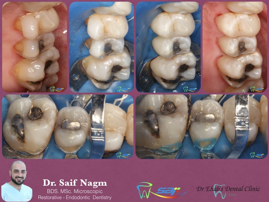 is-content-caseimages--7110-1_class V bucally .009.jpeg