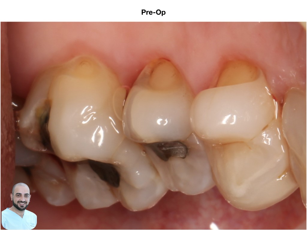 is-content-caseimages--7110-2_class V bucally .002.jpeg