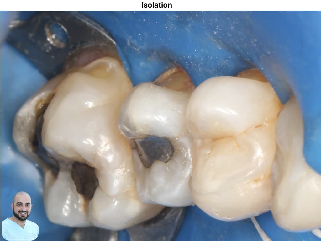 is-content-caseimages--7110-3_class V bucally .003.jpeg