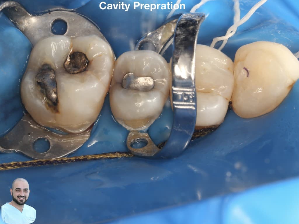 is-content-caseimages--7110-4_class V bucally .004.jpeg