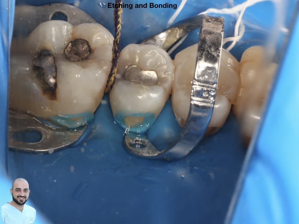 is-content-caseimages--7110-5_class V bucally .005.jpeg