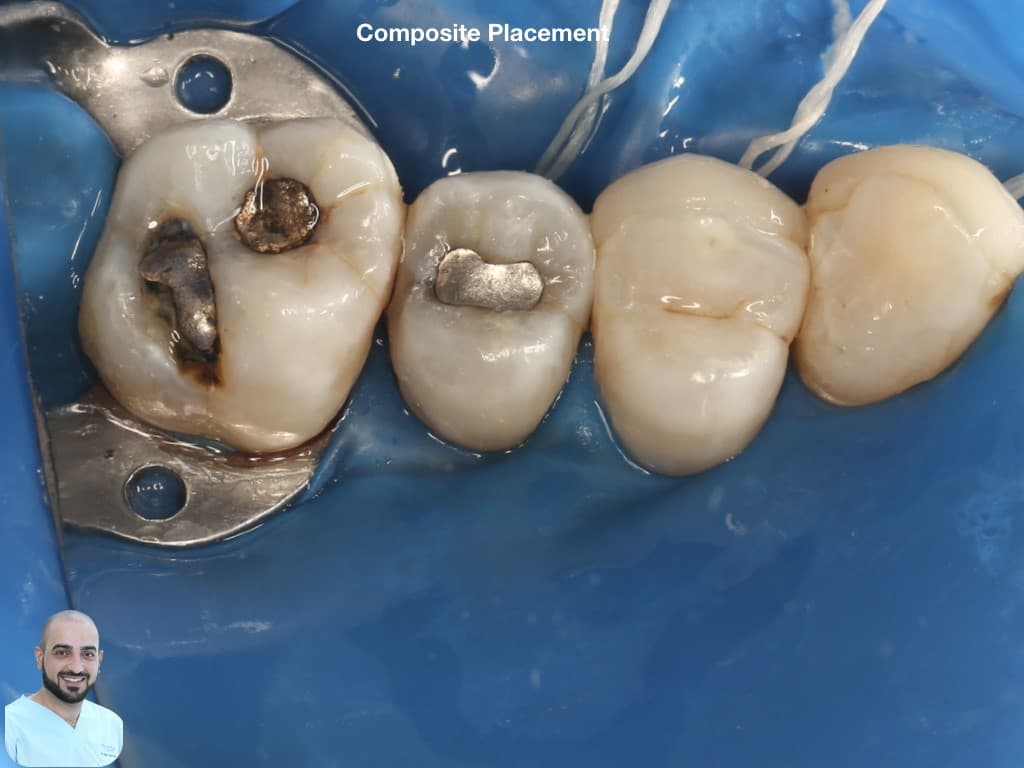 is-content-caseimages--7110-6_class V bucally .006.jpeg