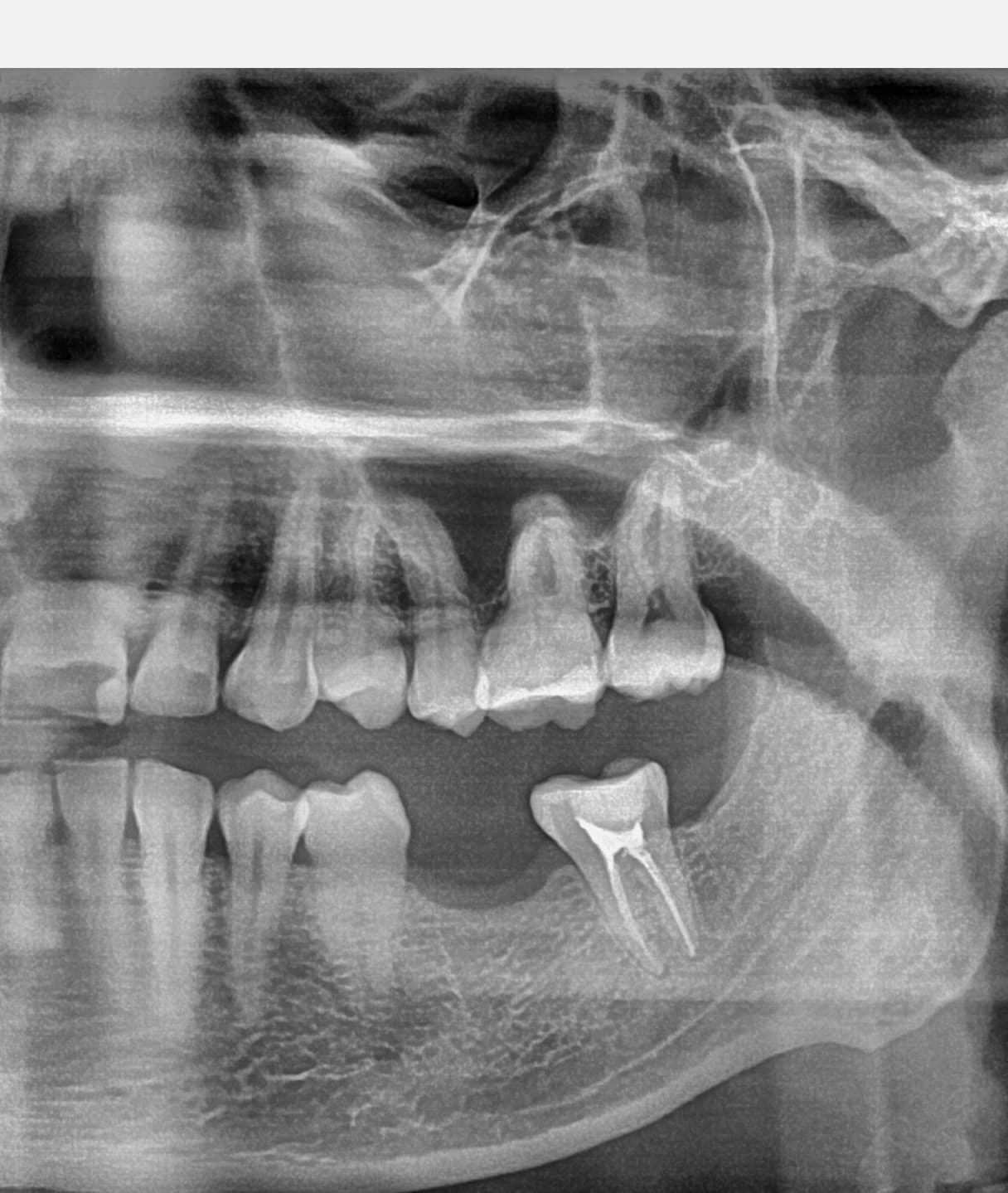 is-content-caseimages--7476-1_Apicoectomy 37 %2D 8.jpg