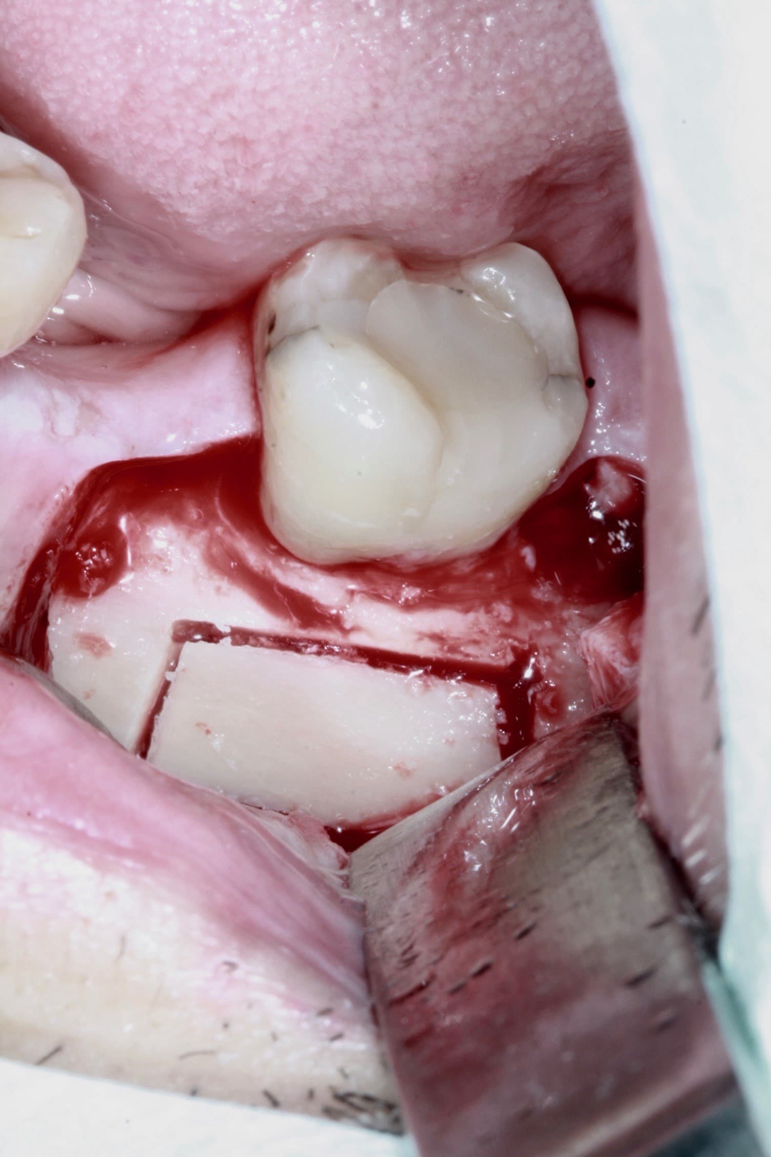 is-content-caseimages--7476-2_Apicoectomy 37 %2D 1.jpg