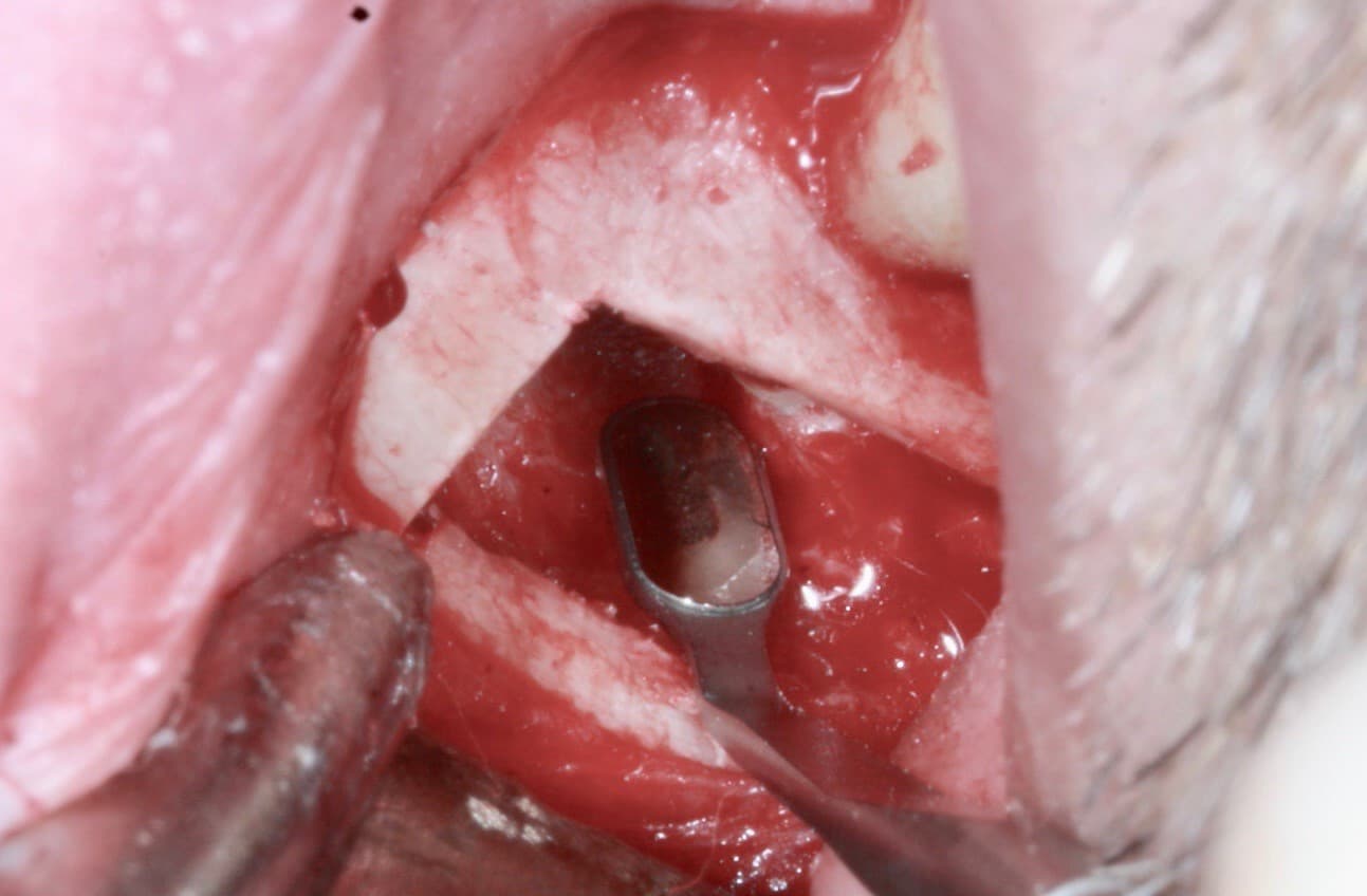 is-content-caseimages--7476-4_Apicoectomy 37 %2D 3.jpg