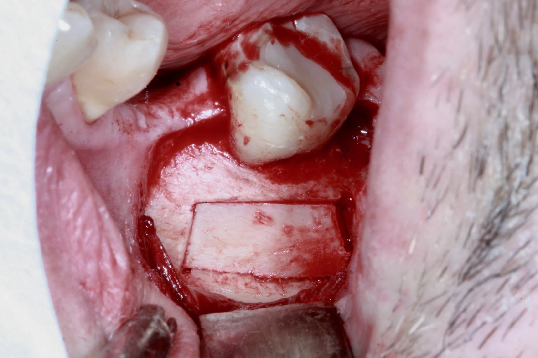 is-content-caseimages--7476-5_Apicoectomy 37 %2D 6.jpg