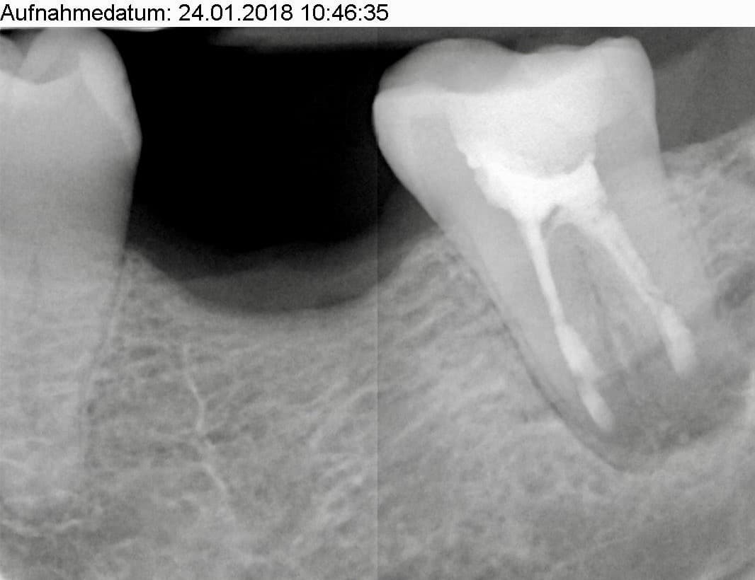 is-content-caseimages--7476-6_Apicoectomy 37 %2D 9.jpg